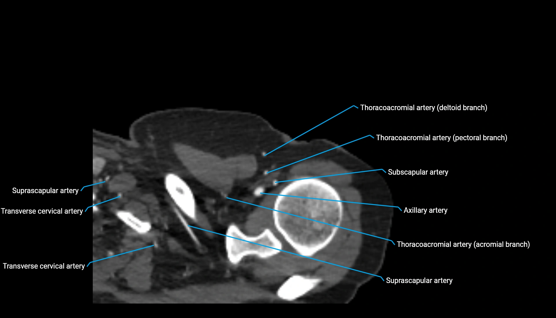 CTA upper limb axial cross sectional anatomy labelled image 327 (1).webp